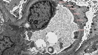 General Outline Pathology of Glomerulonephritis [upl. by Gaivn]