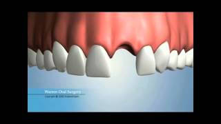 Single Missing Tooth Replacement Options [upl. by Goddord]