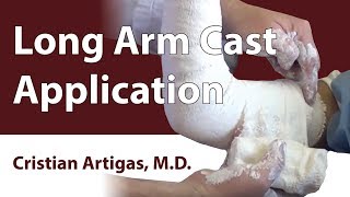 Long Arm Cast Application [upl. by Manly]