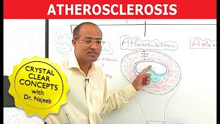 Atherosclerosis  Pathophysiology [upl. by Gaven846]