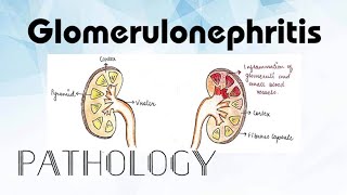 Glomerulonephritis Pathology [upl. by Endres]