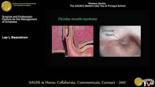 Surgical treatment for achalasia [upl. by Sneve891]