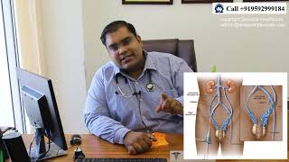 Varicocele Embolization vs Microsurgery in Hindi  Varicocele Embolization ke Nuksan aur Failure [upl. by Dreyer710]