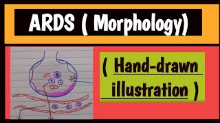 Acute Respiratory Distress Syndrome [upl. by Trini355]