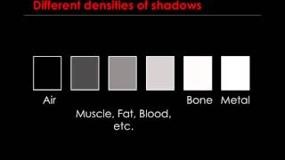 XRay  What to Expect UW Medicine [upl. by Hasheem]