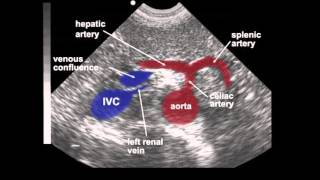 Atheroma  Pathology mini tutorial [upl. by Jarrid676]