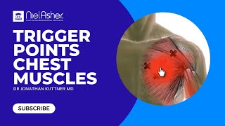 Chest Pain  Trigger Points [upl. by Nwavahs]