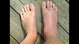 SPRAINED or BROKEN Ankle  Doctor Guide [upl. by Roderigo]