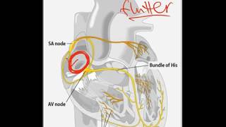 Atrial Flutter  Dr Jamal USMLE [upl. by Alyworth]